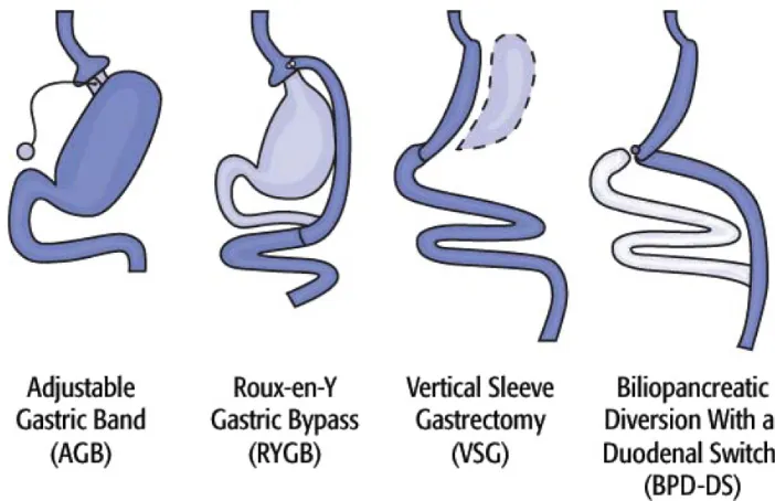 Figure 3 Commonly used bariatric surgery procedures.Notes: From Weight Control Information Network and National Institute of Diabetes and Digestive and Kidney Diseases.116 image used with permission from Walter Pories, MD, FACS