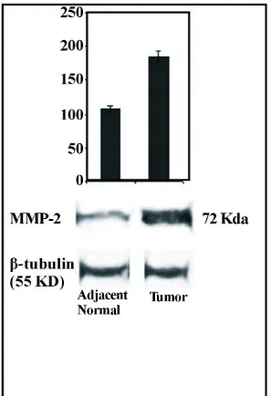 Figure 2. Zymographic analysis for gelatinolytic activity of αvβ3 associated MMP-2 in breast tumor and adjacent normal tissue