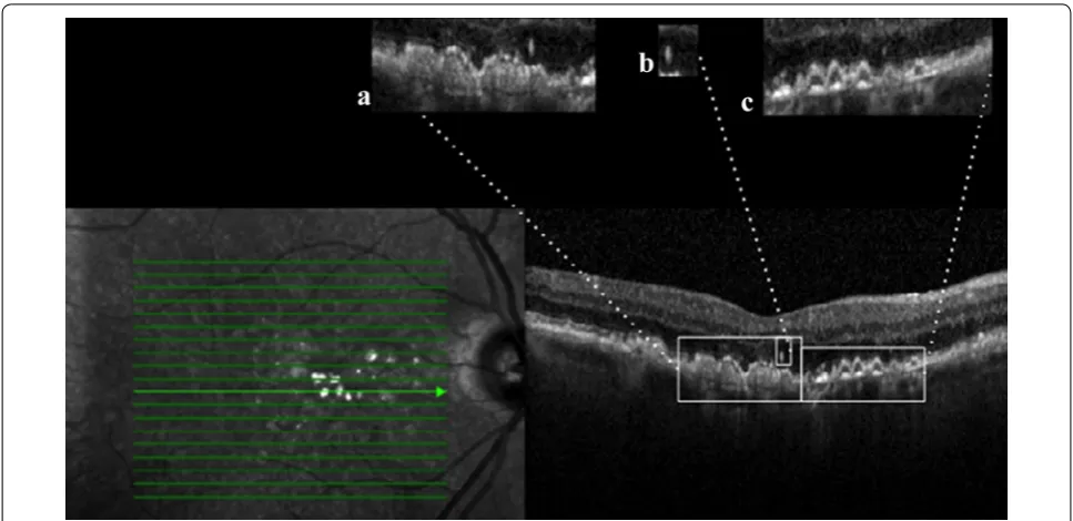 Fig. 2 Interpolation between microperimetric map and SD-OCT scans. Microperimetric map and BCEA area were superimposed onto infrared image