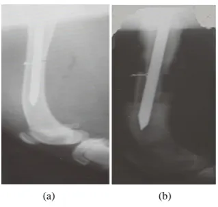 Figure 7. Radiography of case N˚3 showeing alignement of two abouts (a), (b) a beginning of callus formation