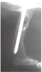 Figure 8. A radiograph at two months showing a complete inte- gration of bone with significant narrowing of callus volume