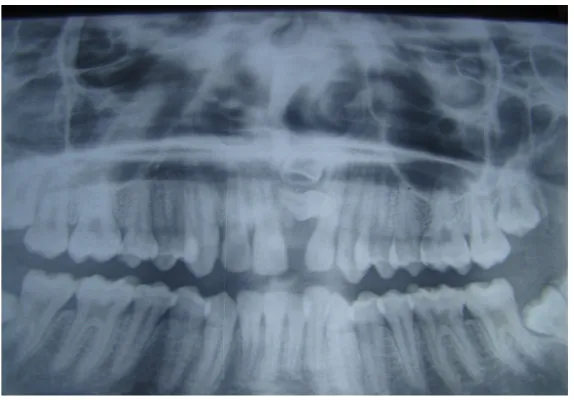 Figure 9. Pre operative photo showing missing central incisor. 