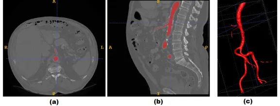Fig. 3. Applying morphological erosion on images with or without edge enhancement. (a) Original slice in axial view (the square indicates the location of abdominal aorta)