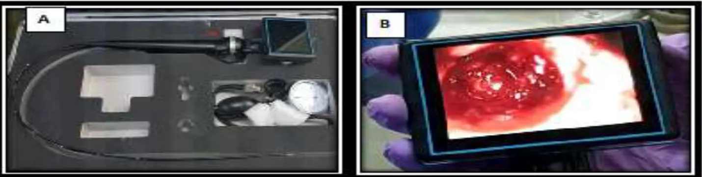 Figure  5:  (A)  Endoscopic  parts assembled together,  (B)  Endoscopic monitor  turned  on  displaying implant  bed  and  membrane with clarity 