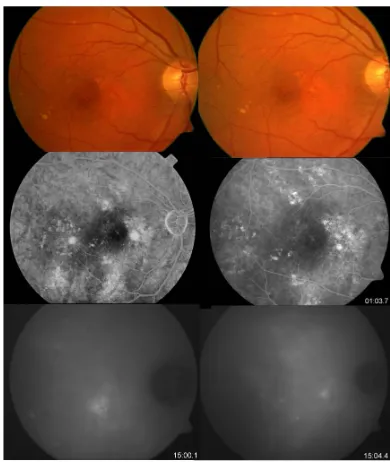 Figure 1. Patient with recurrent CSC in the left eye. Pretreatment (left side) OCT confirmed the presence of a serous neurosensory detachment under the fovea