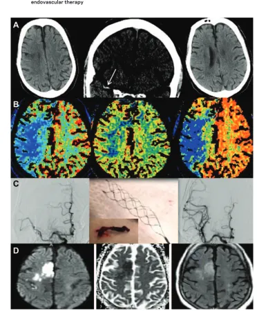 Figure 2An example of applying the CT protocol to triage patients with acute ischemic stroke for