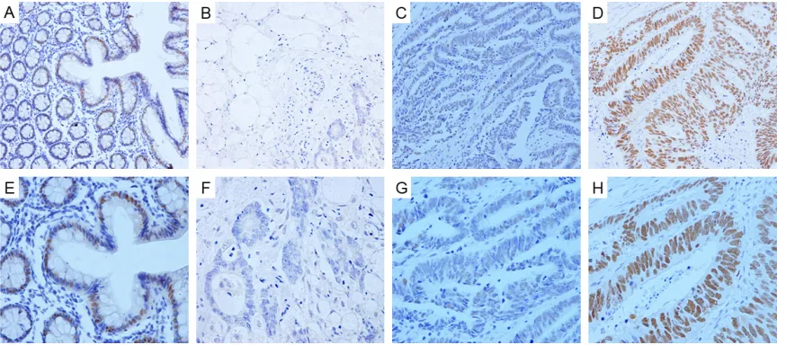 Figure 1. Representative immunohistochemical staining of OAS1 in normal colorectal mucosa and colorectal cancer tissues (Original magnification, A-D: × 200; E-H: × 400)