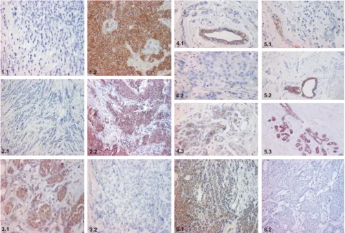 Table 7: Immunohistochemistry differentiates ductal and lobular carcinomas
