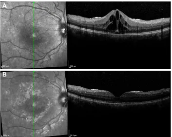 Figure 2 Fluorescein angiography of a 46-year-old female with sarcoidosis showing diffuse fluorescein pooling and leakage (A) and intraretinal fluid accumulation at the macula on optical coherence tomography (B).