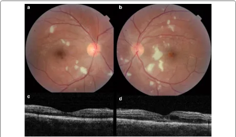 Fig. 3 Fundus photographs of the right (a) and left (b) eyes of a 28 years old male patient with presumed retinitis secondary to Chikungunya virus infection reveals cotton-wool spots in both eyes and retinal hemorrhage and macular edema in the left eye