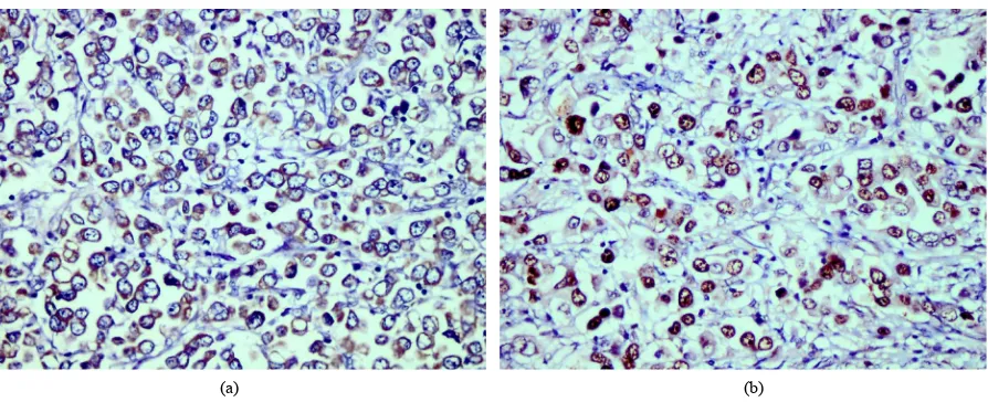 Figure 4. Diffuse component of a mixed type gastric carcinoma showing HER-2/neu IHC score 3+ (a) and a high score Ki-67 nuclear staining (b), (×400)