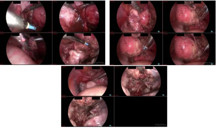 Figure 1. The figures of resection of the adenomyosis  and perlaparoscopic cystectomy 