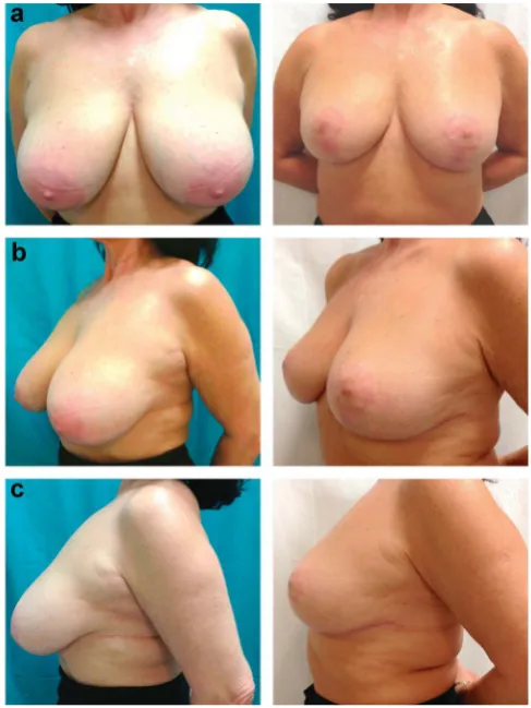 Figure 1. (a) anterior; (b) oblique; (c) lateral views of a patient preoperatively (left column) and postoperatively (right column)