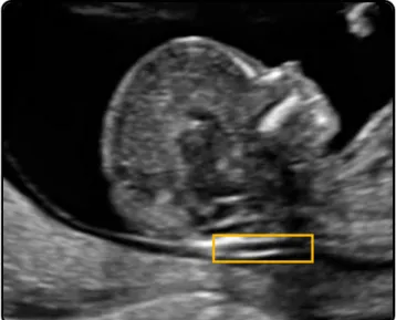 Fig. 1. Sample ultrasound image with highlighted nuchal translucency.