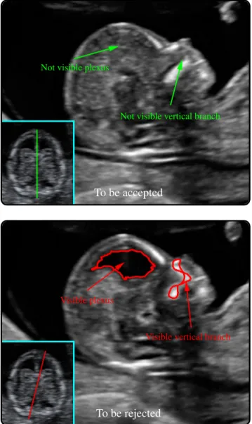 Fig. 2. Mid-sagittal (top) and not mid-sagittal (down) sections, with falx cerebri (framed)