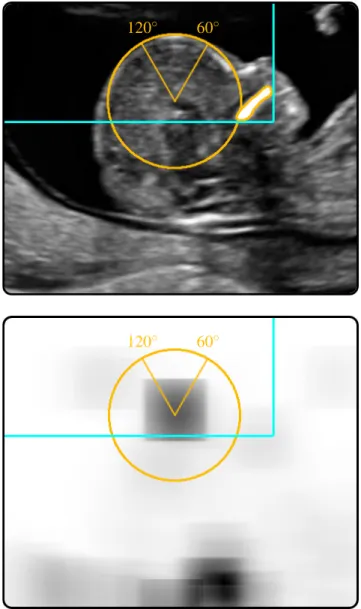 Fig. 12. Rectangular region of interest (located through the jaw) with the superimposed circle (top), obtained by the radial symmetry map S [85,90] (down)