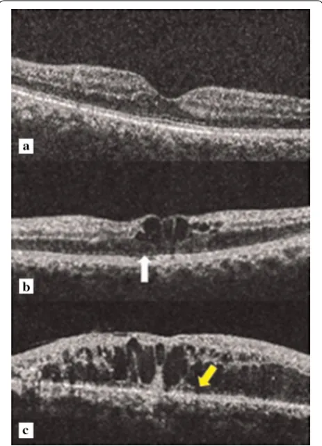 Fig. 1 Spectral domain optical coherence tomography showing grades of disruption of the ELM and EZ