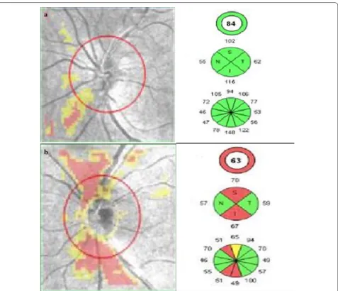 Fig. 2 Retinal Nerve Fiber Layer (RNFL) thickness analysis using optic disc cube 200 × 200 feature depicting on RNFL thickness deviation map a left eye of patient with non-proliferative diabetic retinopathy showing RNFL thinning, b left eye of patient with proliferative diabetic retinopathy show-ing thinning of RNFL