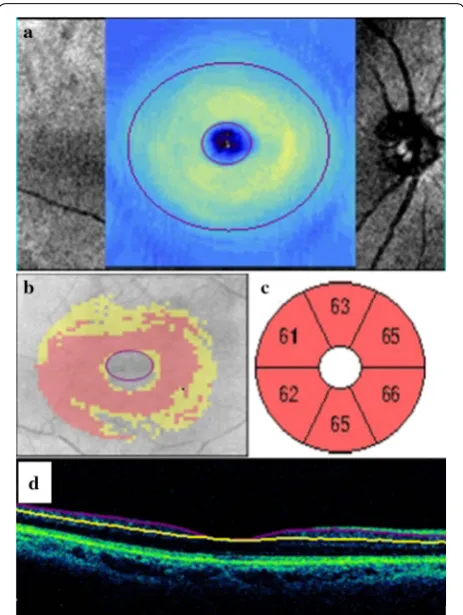 Fig. 3 Ganglion Cell Analysis in a patient of diabetes showing thin-ning in thickness of GCL in GCL thickness map (a), deviation map (b), GCL sectoral quantative analysis (c)