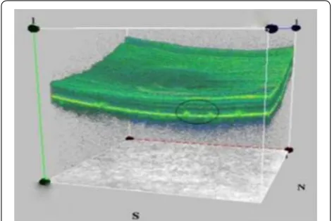 Fig. 4 Three dimensional visualization shows flecks at the level of retinal pigment epithelium (enclosed in black circle)