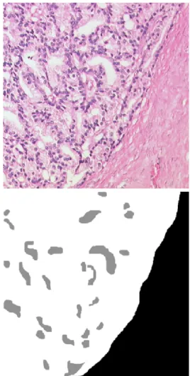 Fig. 3. Upper panel: visual field from a prostatic adenocarcinoma with cribriform differentiation (primary and secondary Gleason grade 4)