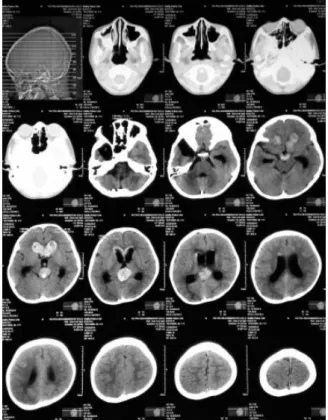 Figure 1. Head CT-scan ahead  of V-P Shunt 