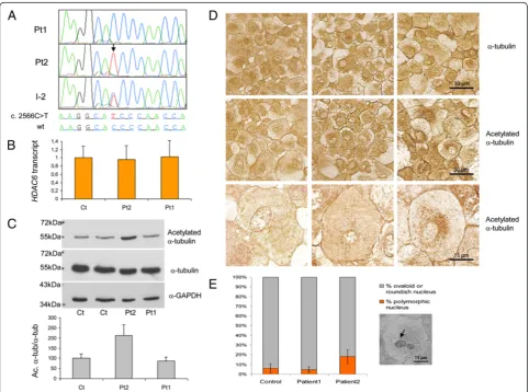 Figure 3 Characterization of the HDAC6 c.2566C>T/p.P856S variant. Amultilobated nuclei in control, Patient1 and Patient2