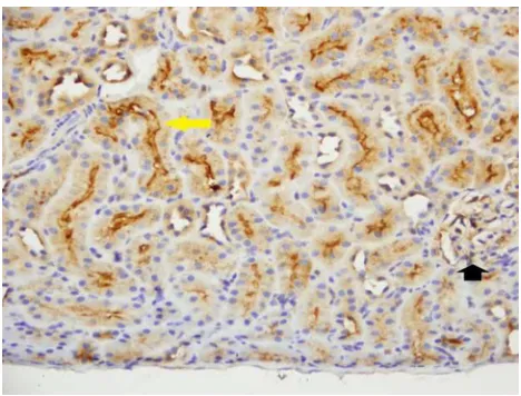 Figure 4 caspase 3 showed light cytoplasmic staining (yellow arrow), intense luminal staining (white arrow) in cortical tubules, and light cytoplasmic staining in glomeruli (black arrow) (×200).