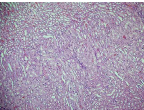 Figure 8 hydroxyethyl starch (hes) in the obstructive kidney. Degeneration in the tubular epithelium, edema in the tubular epithelium, tubular dilatation, tubular atrophy, interstitial inflammation, and interstitial fibrosis are severe