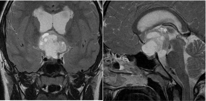Figure 2T2-weighted MRI (left coronal image, right sagittal image) showing the suprasellar mass extending