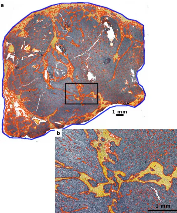 Fig. 5. Limits of automatically detected cancer stroma (in red) and tumor tissue (in blue) are superimposed onto the color image acquired at 2,700 dpi, using the slide scanner