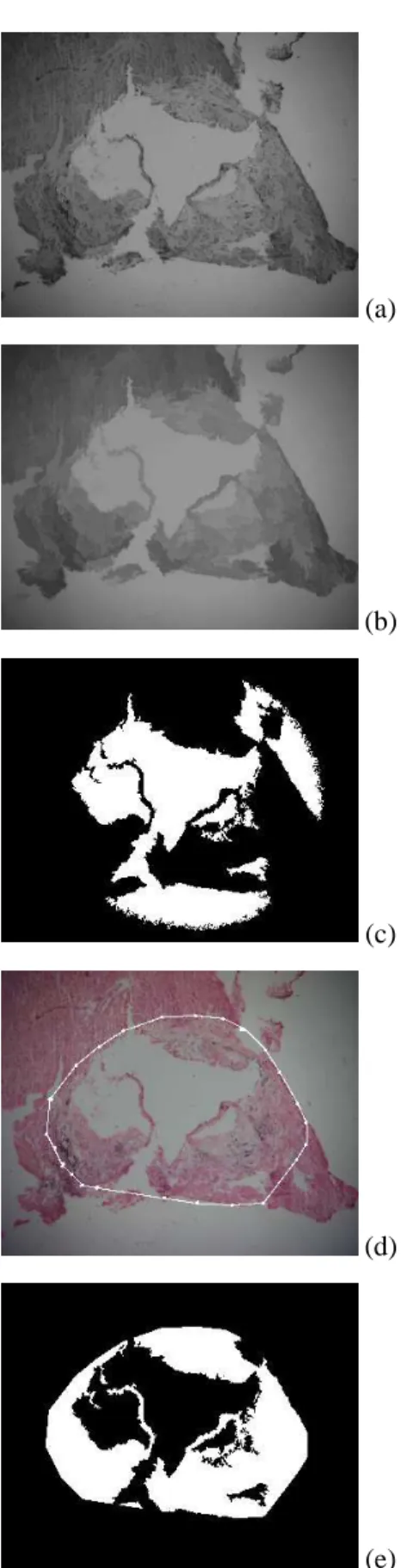 Figure 4. Interactive segmentation of the region of lesion: (a) Simplified green component using an opening by reconstruction, f G ; (b) followed by closing by reconstruction, f G ; (c) negative of the binary mask without empty image zones, I g ; (d) manua