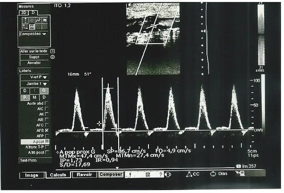 Figure 3. Ultrasound focused stenosis of more than 60%.                    