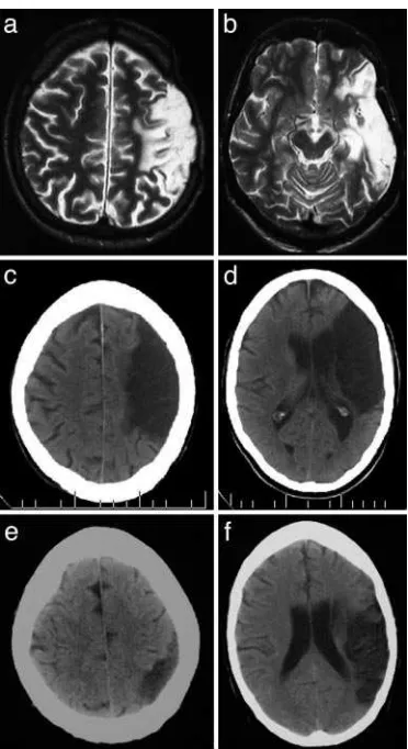 Fig. 1.Structural brain scans for patients S.A. (P.R. (a and b), S.O. (c and d), ande and f).
