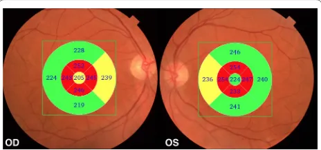 Fig. 1 Examples of Topcon 3D OCT‑2000 generated full‑thickness macular thickness parameters are below normal range, particularly in macular measurements in the right (OD) and left (OS) eye of a patient with Alzheimer’s disease