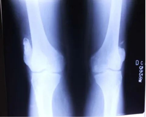 Figure 1. X-ray bilateral knees AP view showing giant loose body in left knee joint. 