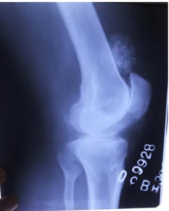 Figure 2. X-ray left knee lateral view showing giant loose body. 