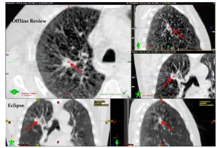 Figure 1. Treatment isocenter location (marked as a red arrow) after on-line match in the offline review (top) and manual isocenter transfer to the Eclipse treatment planning system (bottom)