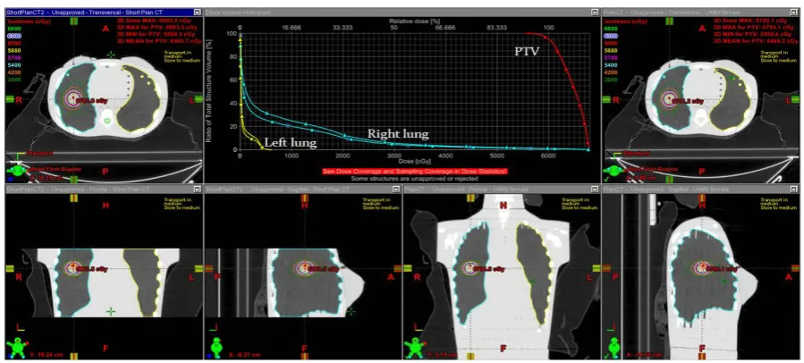 Figure 2. Phantom plan study 1-truncated original pCT (left, represented in DVH as a solid triangle) vs