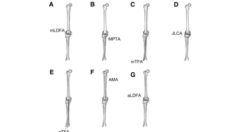 Fig. 1 Measurement methods of common parameters of lower extremity alignment studied in this paper