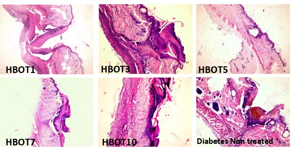Figure 7. Histological view of wound closures. Non-treated diabetic rat showed persistent wound gap whereas the HBOT diabetic rats showed improved wound closure