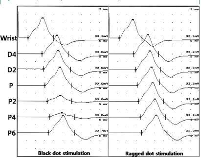 Figure 3Example of short-segment ulnar nerve conduction study