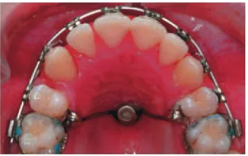 Figure 11 Debonded transpalatal arch and theresultant anchorage loss