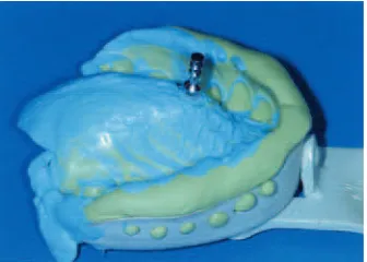 Figure 19 Ortho analogue positioned in impression prior to casting