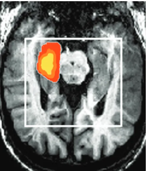 Table 1 Demographic and clinical characteristics of the studysample of patients with video/EEG confirmed temporal lobeepilepsy