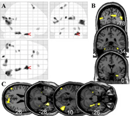 Figure 1. Whole brain activations for the con-z-coordinates, respectively, showing activations inthe bilateral parahippocampus (predominately right),cuneus, bilateral hMTview (trast ride–walk (P < 0.001 unc.) in a glass brainA)