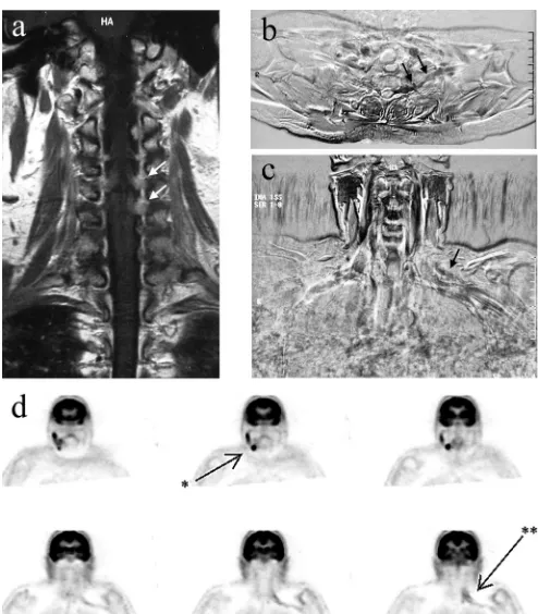 Figure. (A) Gadolinium-enhanced T1-weighted images ofthe cervical spine made at the time of first presentation,showing enhancing cervical roots on the left more pro-nounced than on the right (arrows)