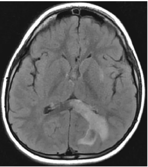 Figure. Axial T2 FLAIR images showing increased signalintensity in the left occipital white mater extending intothe splenium of the corpus callosum.