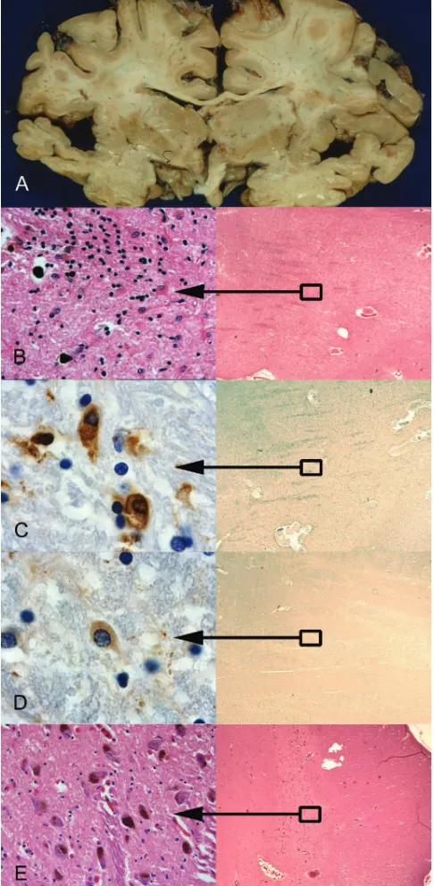 Figure. (A) Coronal section at the level of the basal gan-glia, with atrophy and brown discoloration of the putamendase stain (D)