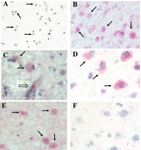 Figure 1. In situ immunohistochemical (IHC) detection ofcytokine receptors and inducible nitric oxide synthase(D) receptors, in affected white matter zones in PVLbrains